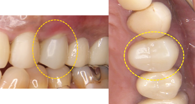 術前レントゲン
