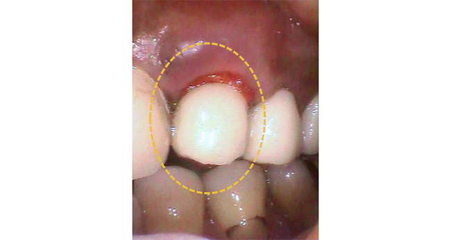 インプラント埋入直後レントゲン