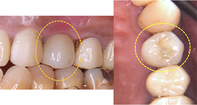 術後レントゲン