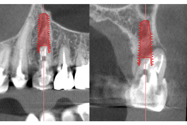 術前レントゲン