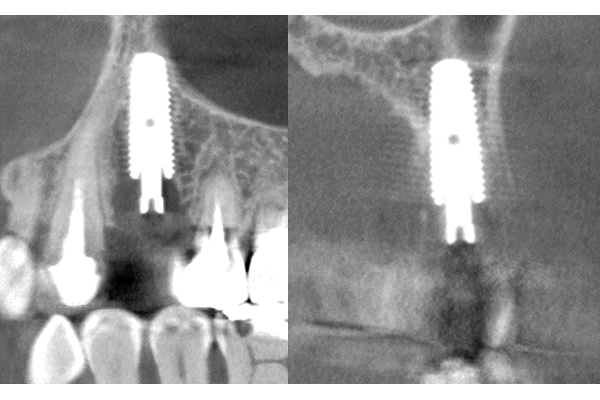 インプラント埋入直後レントゲン