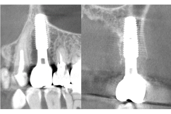 術後レントゲン
