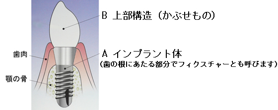 インプラントは上部構造とインプラント体で成り立っています